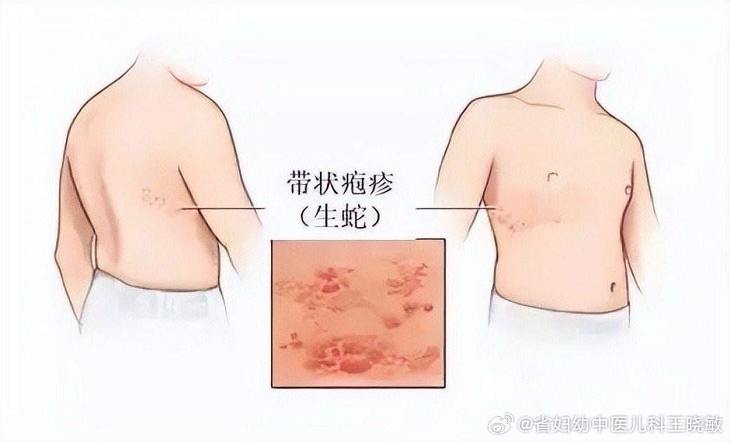 拆快递后揉眼引发眼部带状疱疹病例警示