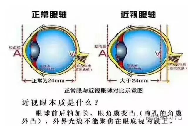多维度视角下的近视治疗最新科技探索